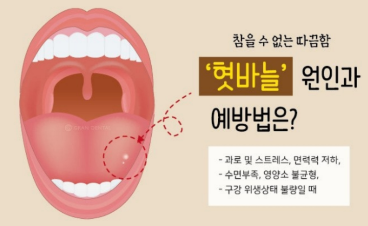 혓바늘-원인