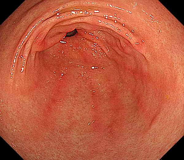 표재성 위염1_출처:속편한TV