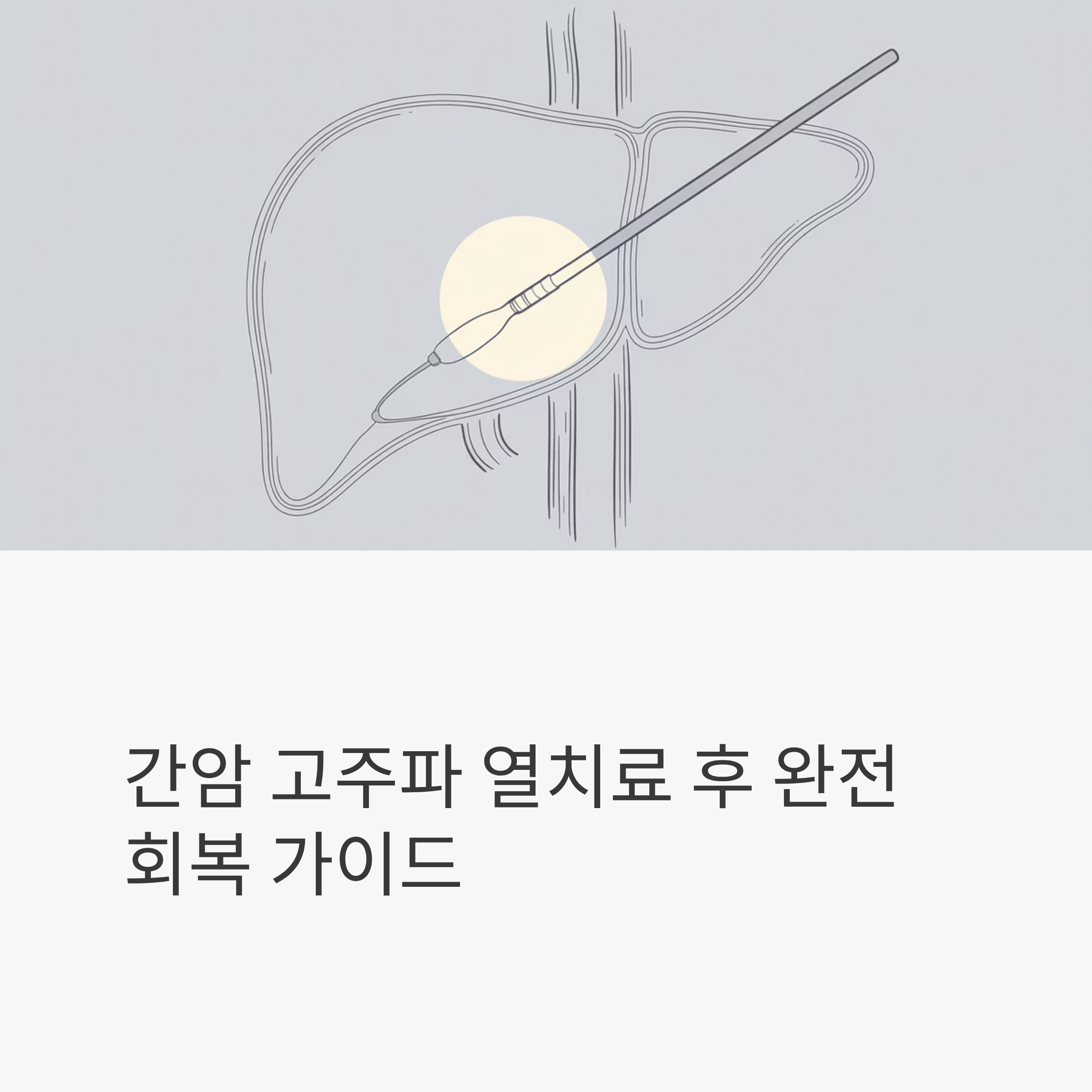 간암 고주파 열치료 재발방지 대표이미지