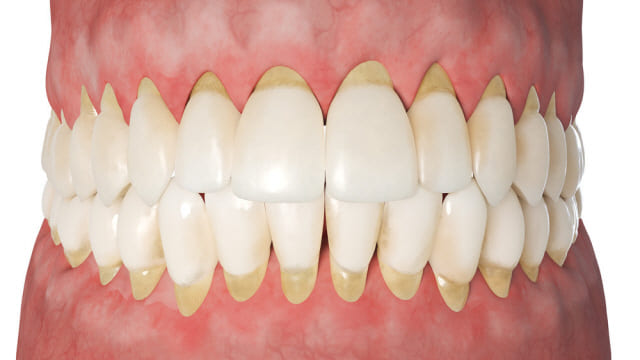 치주 질환, 피부 질환 발병 위험 높여