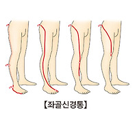 좌골신경통 증상