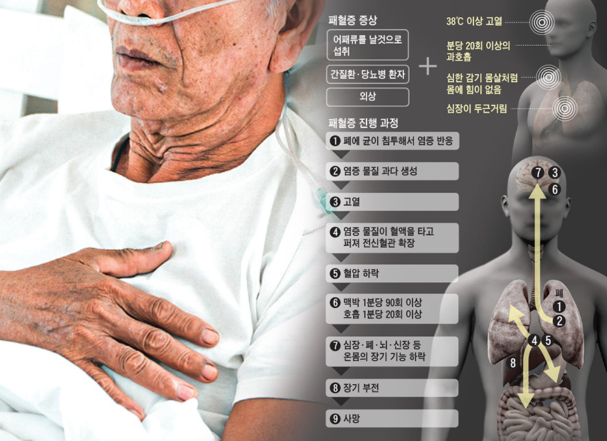 중환자실에 패혈증으로 진료중인 노인