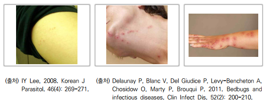 빈대-물린-자국-사진