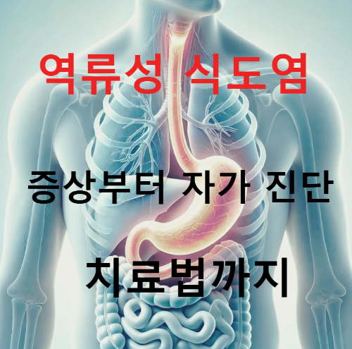 속쓰림과 가슴 통증? 역류성 식도염 증상부터 자가 진단·치료법까지