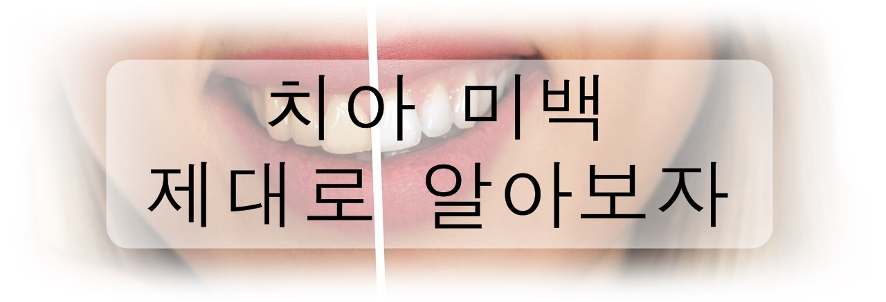 치아미백 제대로 알아보자!