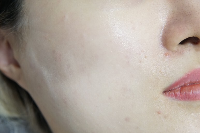 스킨보톡스 후기