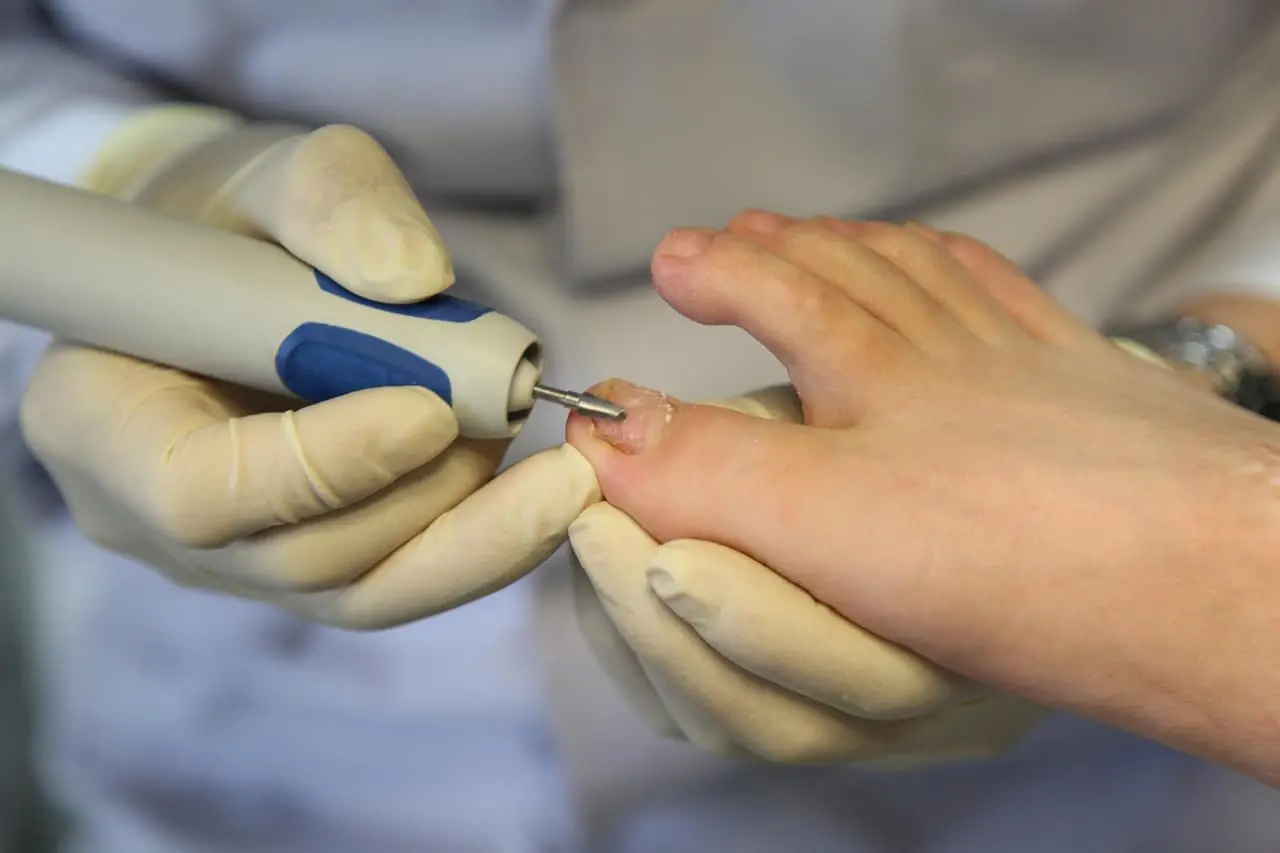 발톱흑색종 초기증상과 멍과의 구분법|놓치면 위험한 발톱 변화