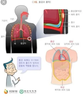 늑막에 물이 차는 이유와 치료 방법_3