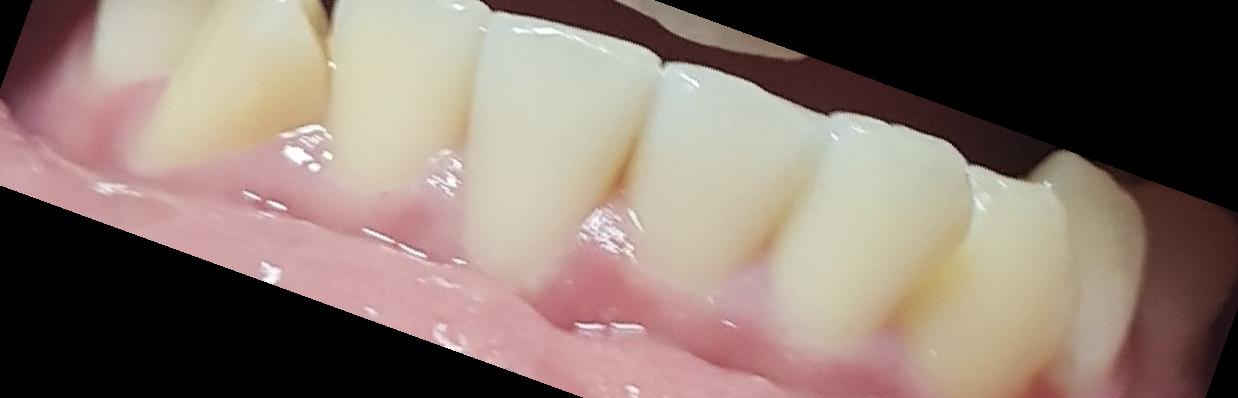 잇몸 내려앉음 치료