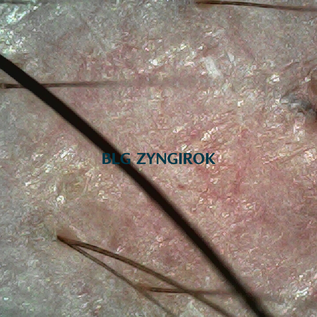 피나모아 복용 9주차 두피사진 - 오른쪽 M자 부위 위치이다.