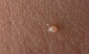 쥐젖 제거방법 가장 안전한 제거방법