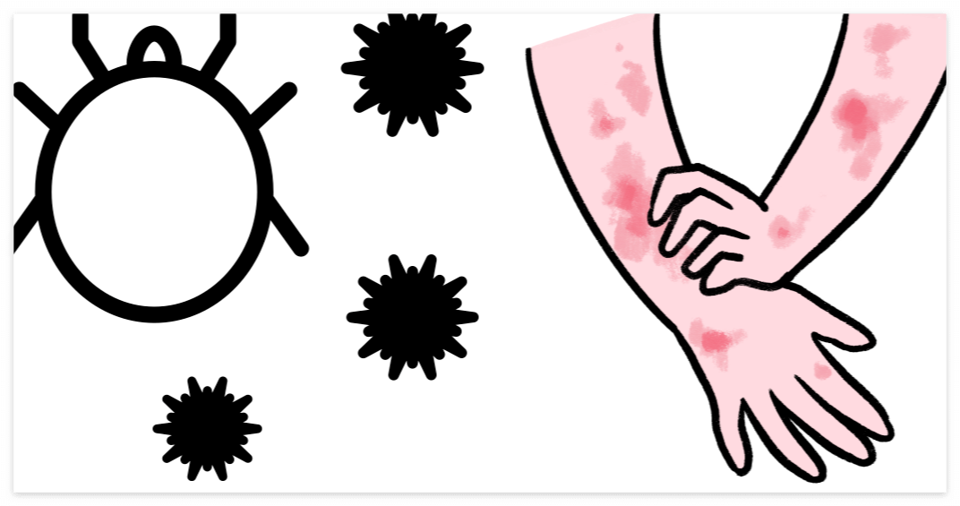 진드기나 해충에 물려 피부에 알레르기 반응이 나타나는 상황을 묘사한 일러스트