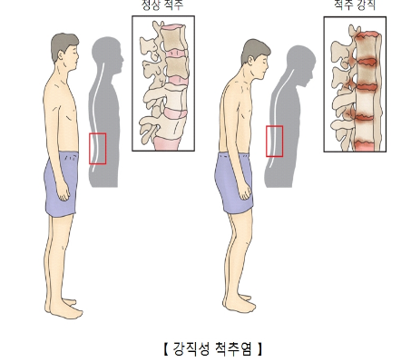 강직성척추염-환자-사진