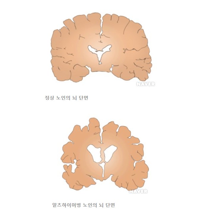 알츠하이머 초기증상 4가지와 대처방법 알아보기
