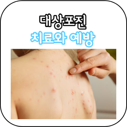 대상포진-썸네일