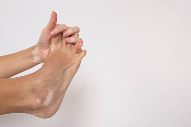 지독한 발 냄새 원인