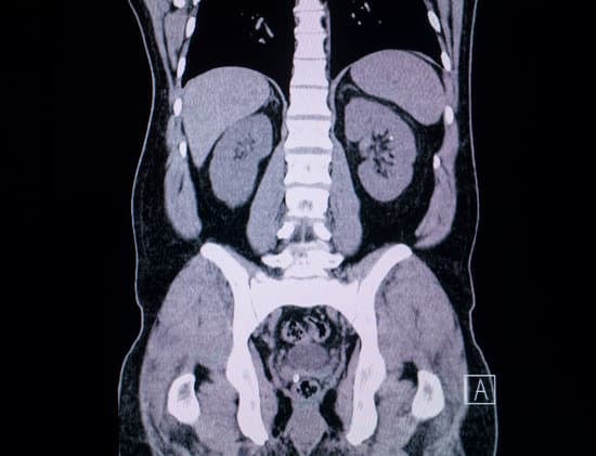 CT 대장조영술 (CT Colonography): 비침습적 대장 검사 방법