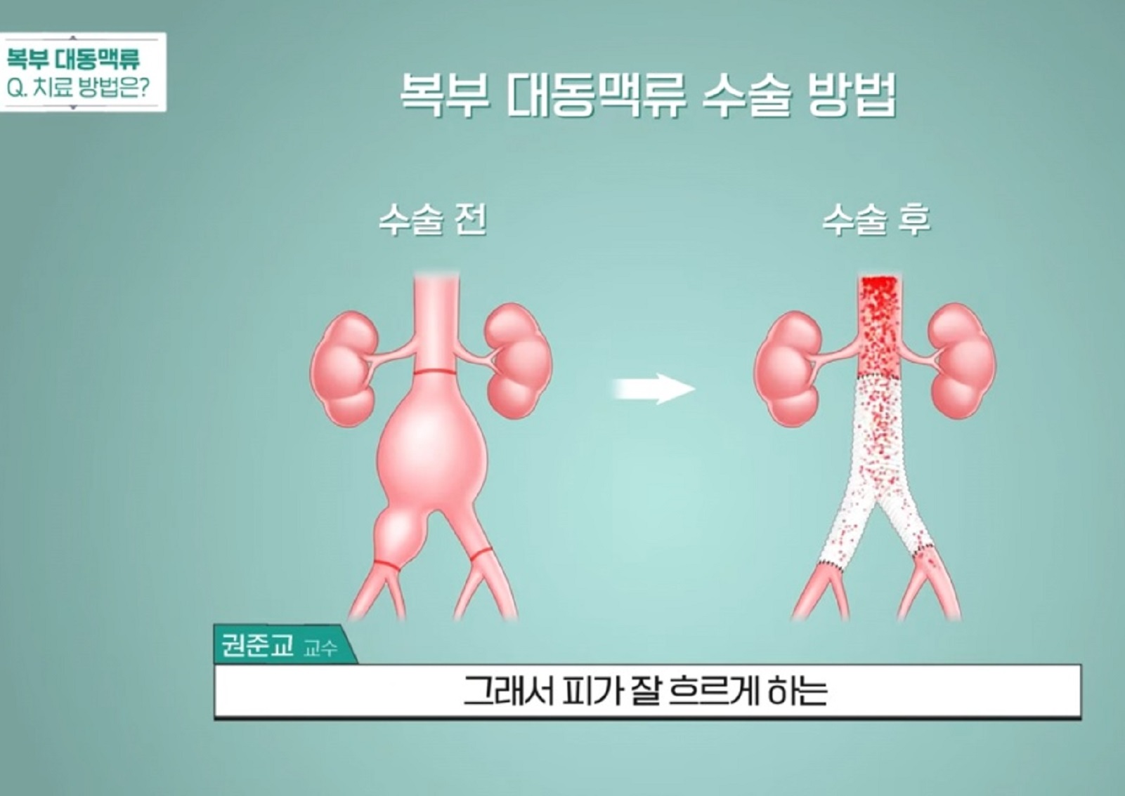 EBS-명의-복부대동맥-수술방법
