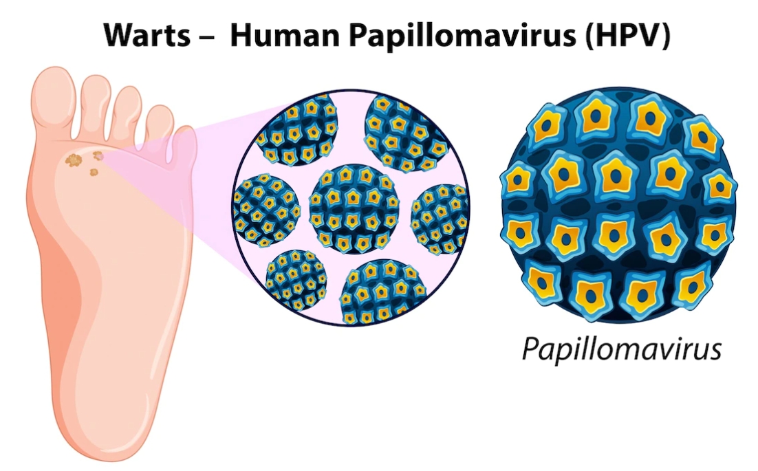 발바닥에 사마귀가 생긴 것을 보여주는 이미지