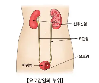 신우신염
