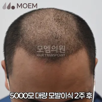 머리카락 이식 3000모 3000모낭 비용과 시술 과정_10