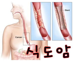 식도암
