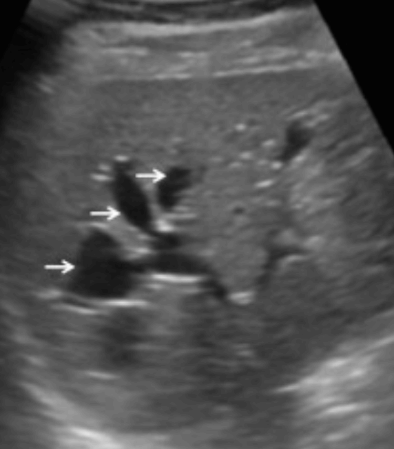 선청성 담관확장증 (Caroli&amp;#39;s disease)