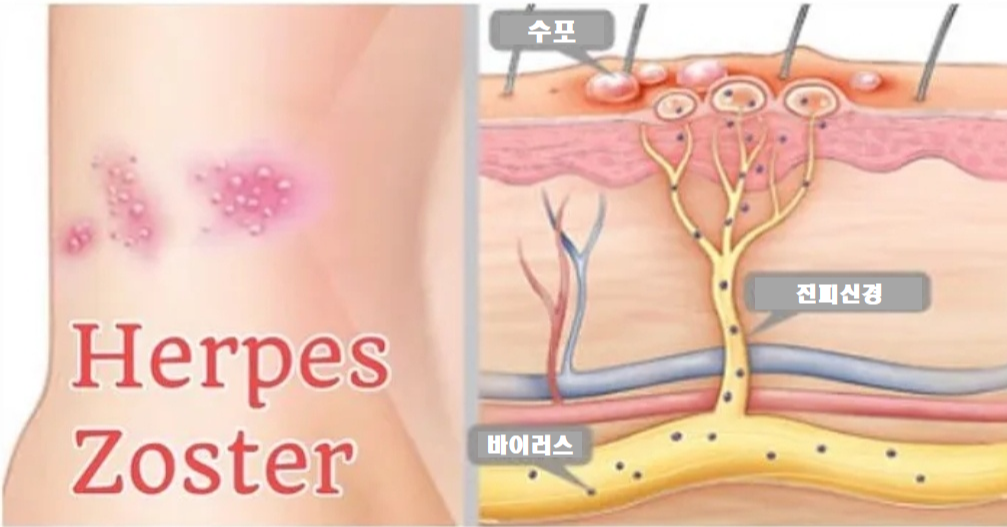 대상포진은 잠복한 수두 바이러스가 다시 활성화되어 발병한다
