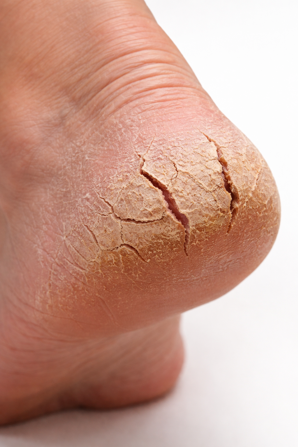 겨울만 되면 발각질이 심해지는 이유