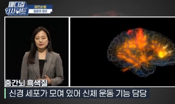 파킨슨병-정의