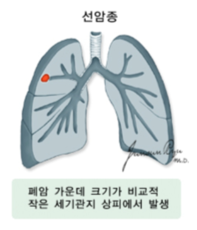 폐선암