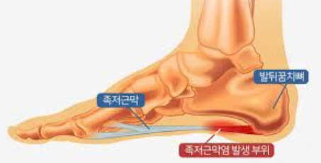 족저근막염의 발생 부위와 증상