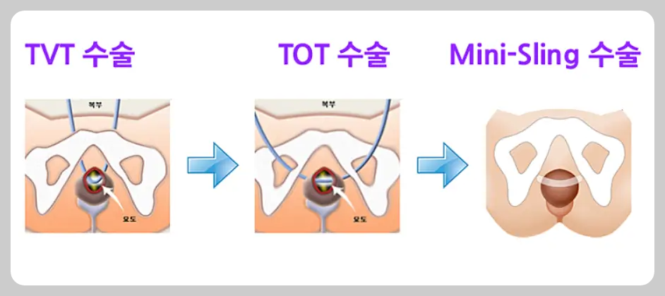 요실금 수술 변천사
