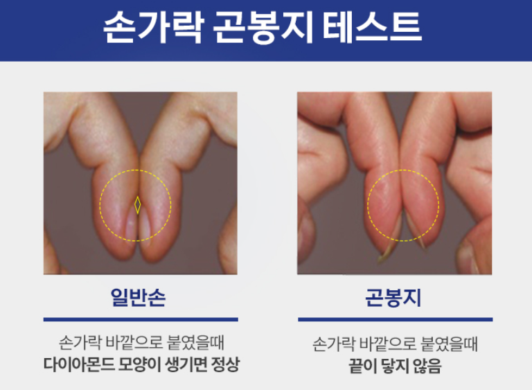 곤봉지와 청색증, 우리 몸이 보내는 심장 위험 경고