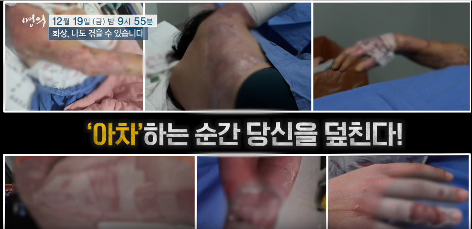 명의 화상 나도 겪을 수 있다