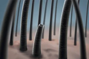 모발이식-4000모-비용