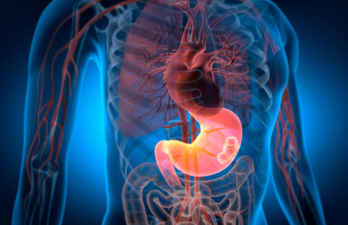 위암과 관련된 사진2