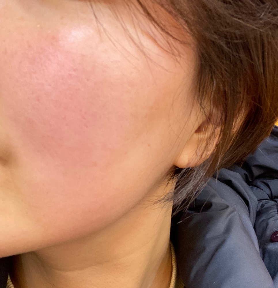 안면홍조증 치료연고