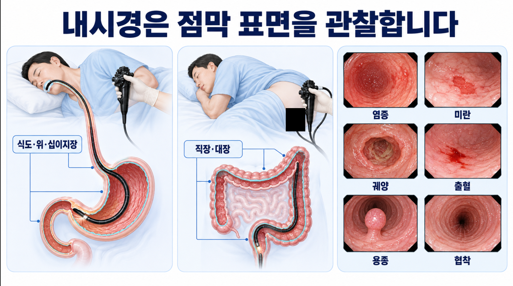 위내시경과 대장내시경의 관찰 부위 및 염증&middot;미란&middot;궤양&middot;출혈&middot;용종&middot;협착 비교