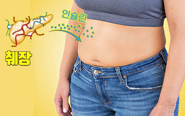 다낭성난소증후군 증상 자가진단 복부비만 체중증가 여자 살찌는병