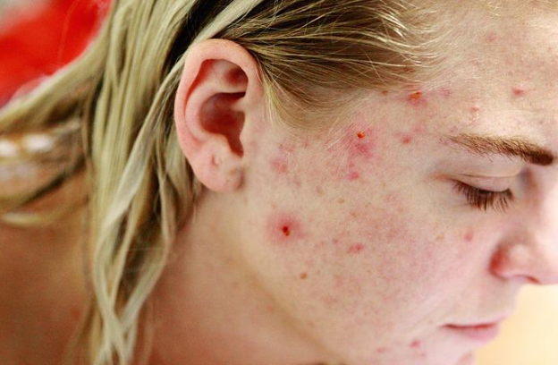 여드름이 난 여성의 피부