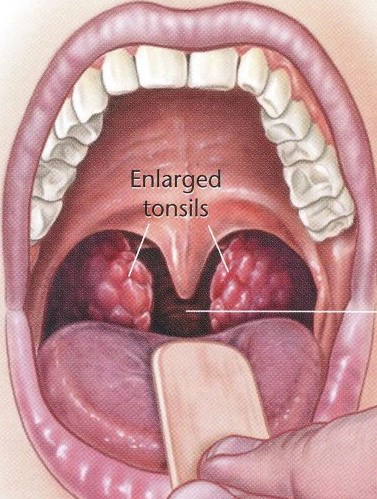편도 비대증 원인 증상 및 편도 절제술 비용 과정