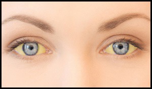 간경화 초기증상 치료법 간이 나쁘면 나타나는 증상 15가지