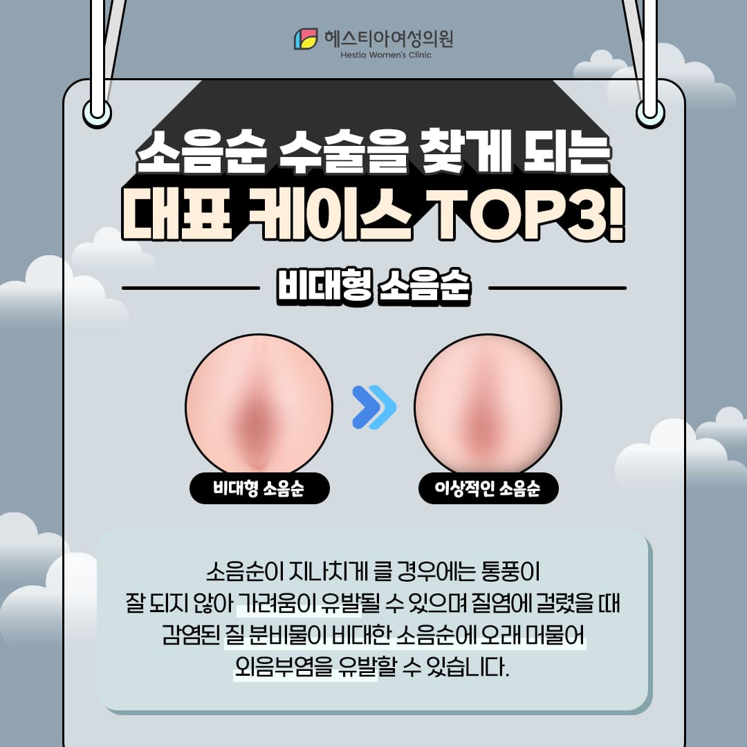 소음순수술을 찾는 소음순변형 두번째 : 비대형소음순