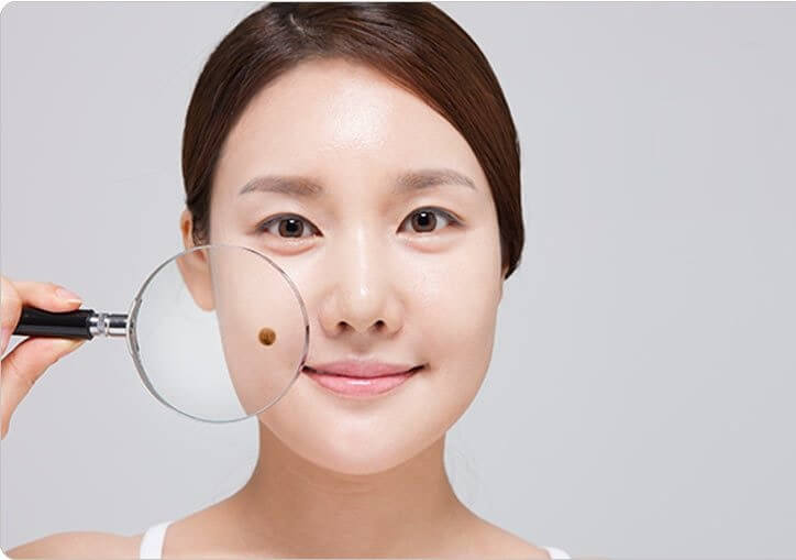 점 빼고나서 관리법