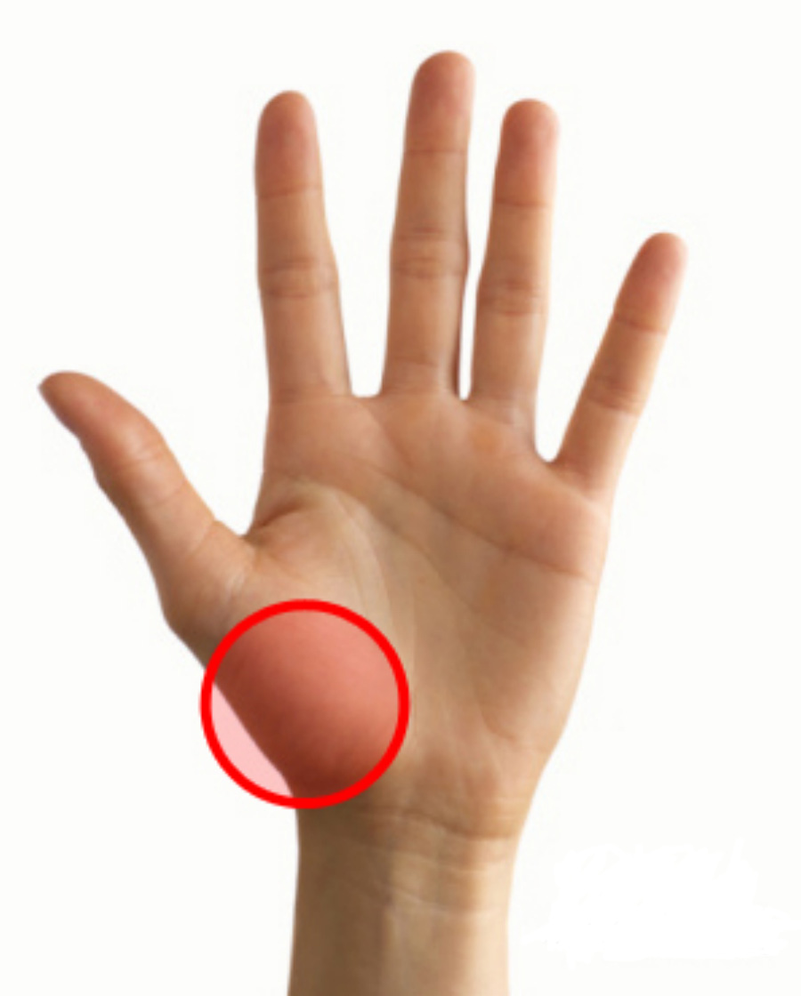 손바닥에서 엄지손가락의 본 관절 부분의 둔덕 부위를 어제라고 하는데 그 부분을 붉게 표시를 한 사진