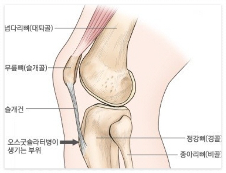 오스굿씨 병
