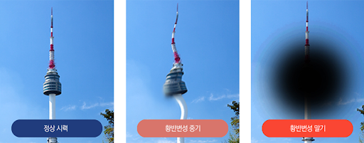 황반변성 증상, 황반변성 치료법, 원인