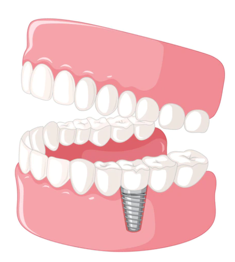 하나의 치아에 임플란트 시술을 한 치아 모형