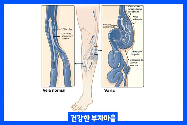 하지정맥류 치료 방법